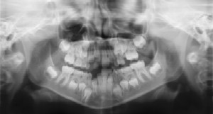 Twinkle Dentist - Dental Radiographs (X-Rays)