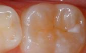 Sealant-Before - Twinkle Dentist